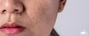 HHRC - Close up shot of a woman's face skin