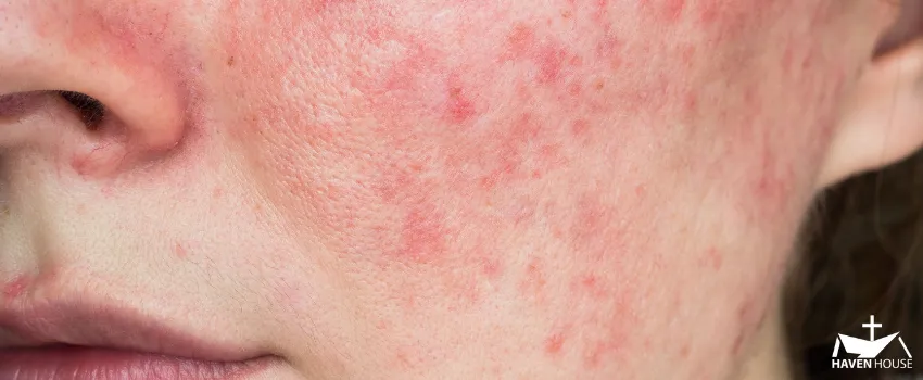 HHRC - Close up shot of a woman's left cheek with rosacea