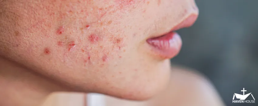 HHRC - Close up shot of a woman's right cheek with acne